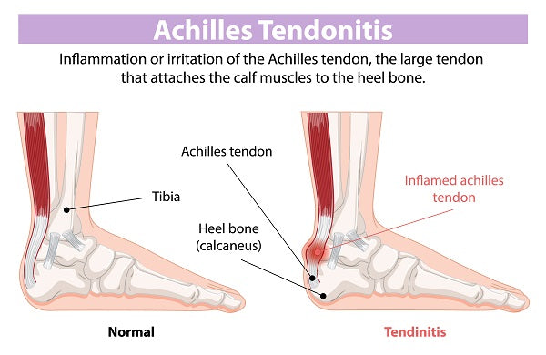 Achilles Tendonitis